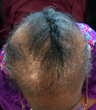 Signs of Alopecia ( hair loss ) in client - HairTalk1