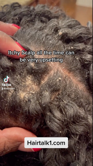 Sebehorric Dermatitis on scalp for HairTalk1
